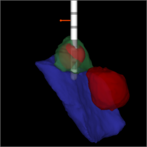 DBS lead location in brain.