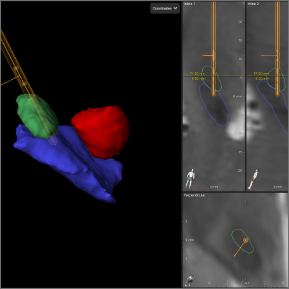 Anatomical segmentation in brain.