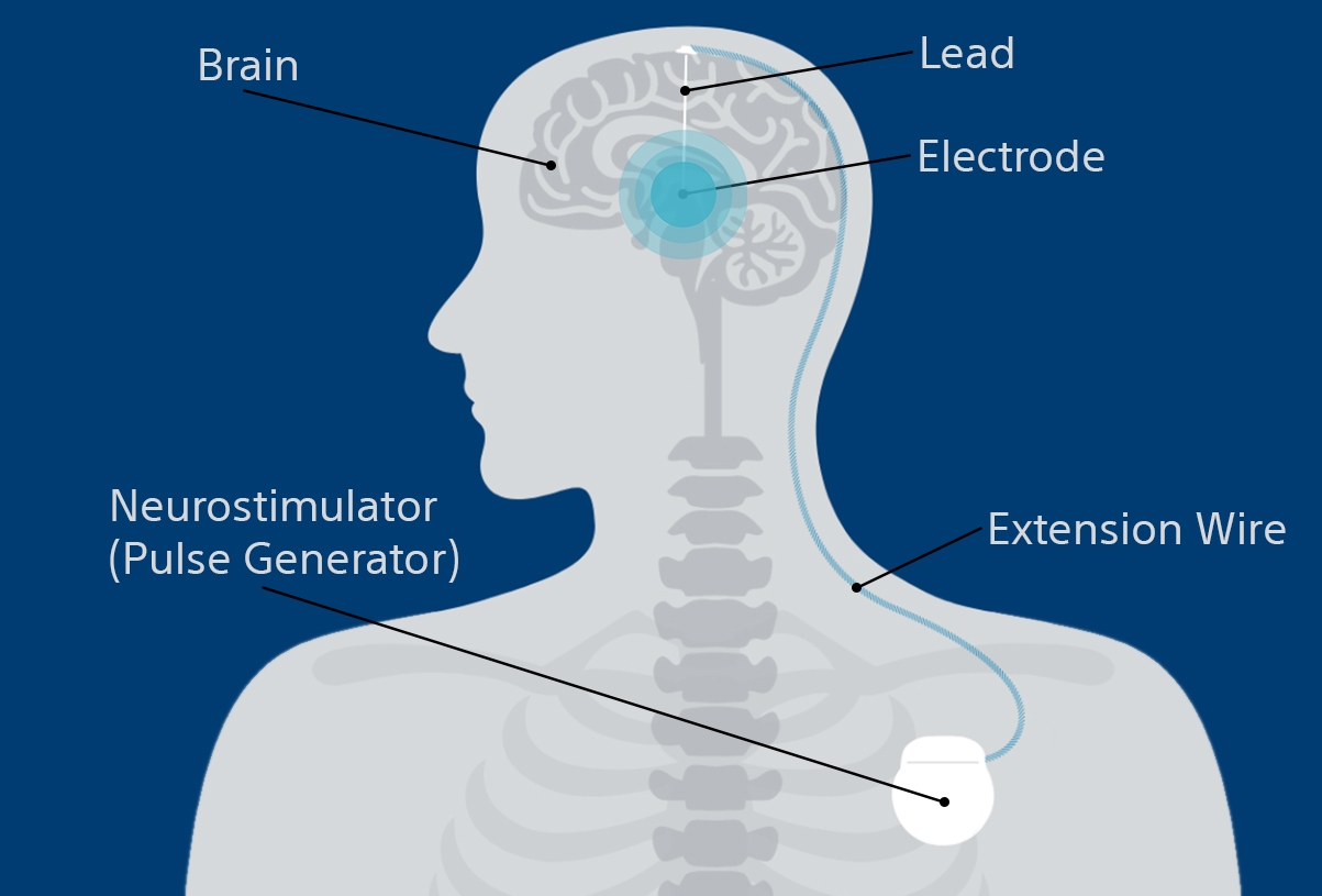 Deep brain stimulation system diagram in upper chest and head. Callouts showing neurostimulator in chest, extension wire connected to lead and electrode within brain.