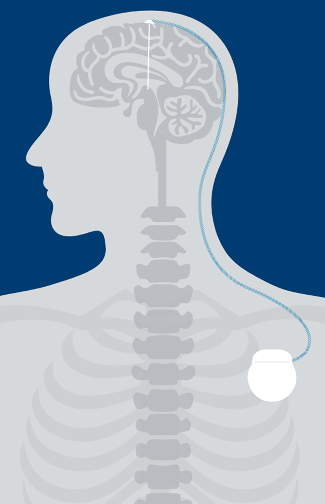 Illustration showing an implanted stimulator with leads connected to the brain.